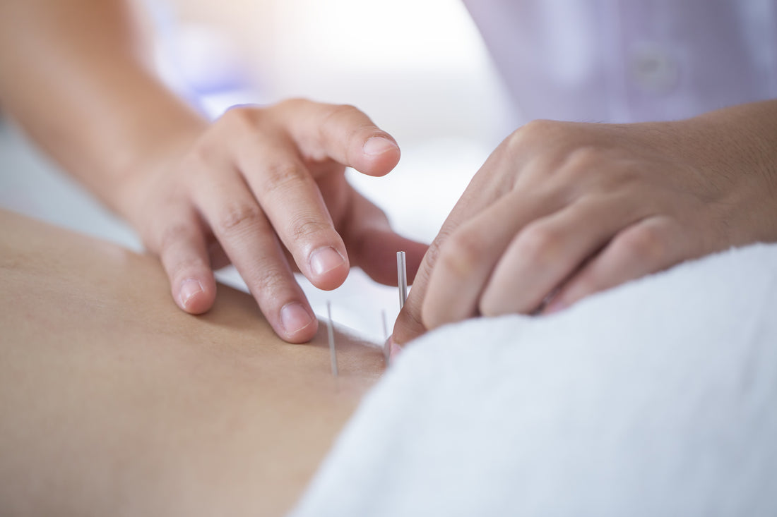 Acupuncture: An Ancient Chinese Healing Practice Against PMS